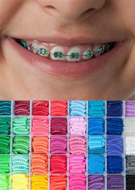 Choosing the Right Color for Your Braces